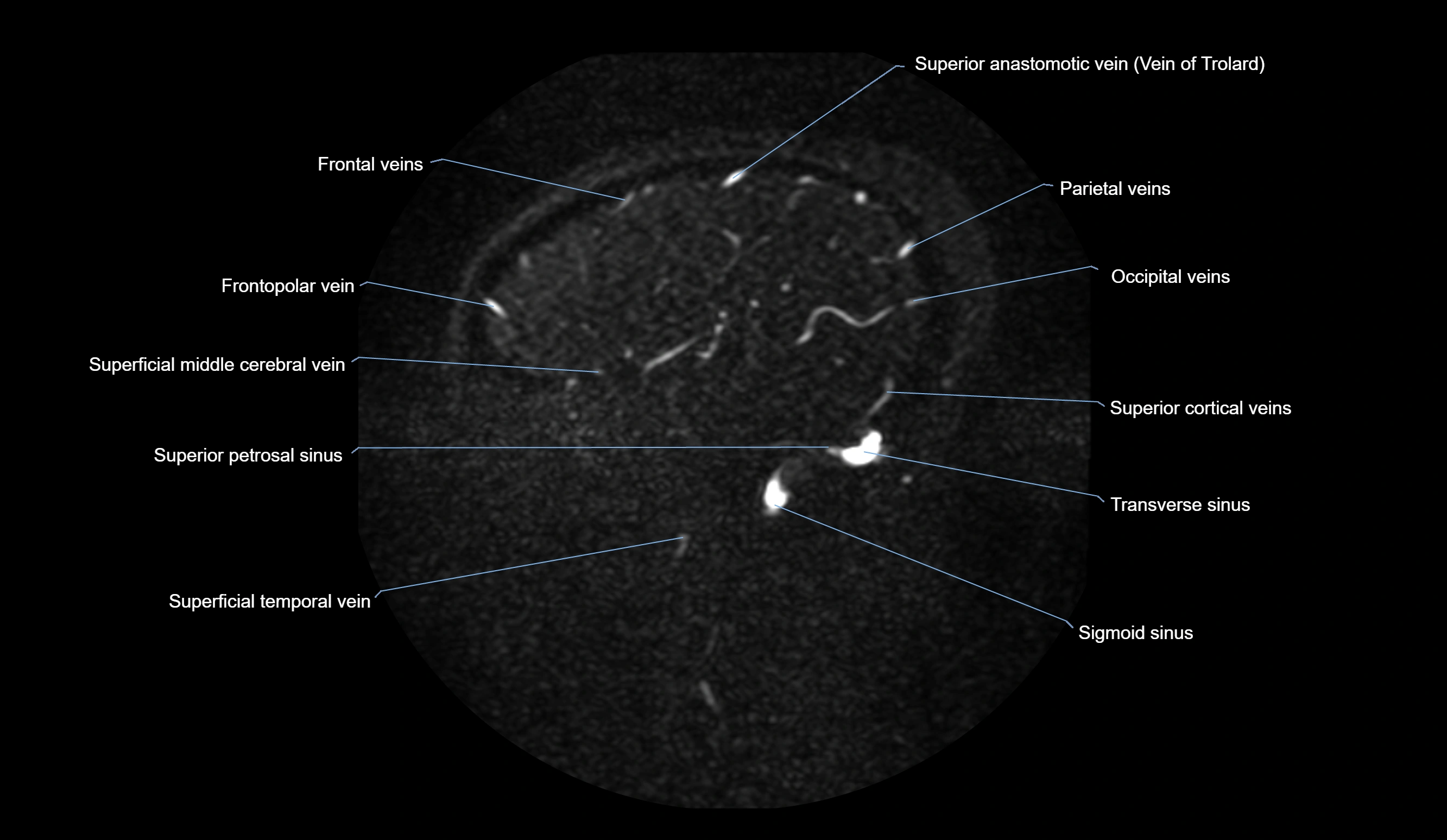 MRV brain sagittal anatomy 3T MRI labelledimages -00066.webp